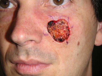 Facial Wound Healing 85